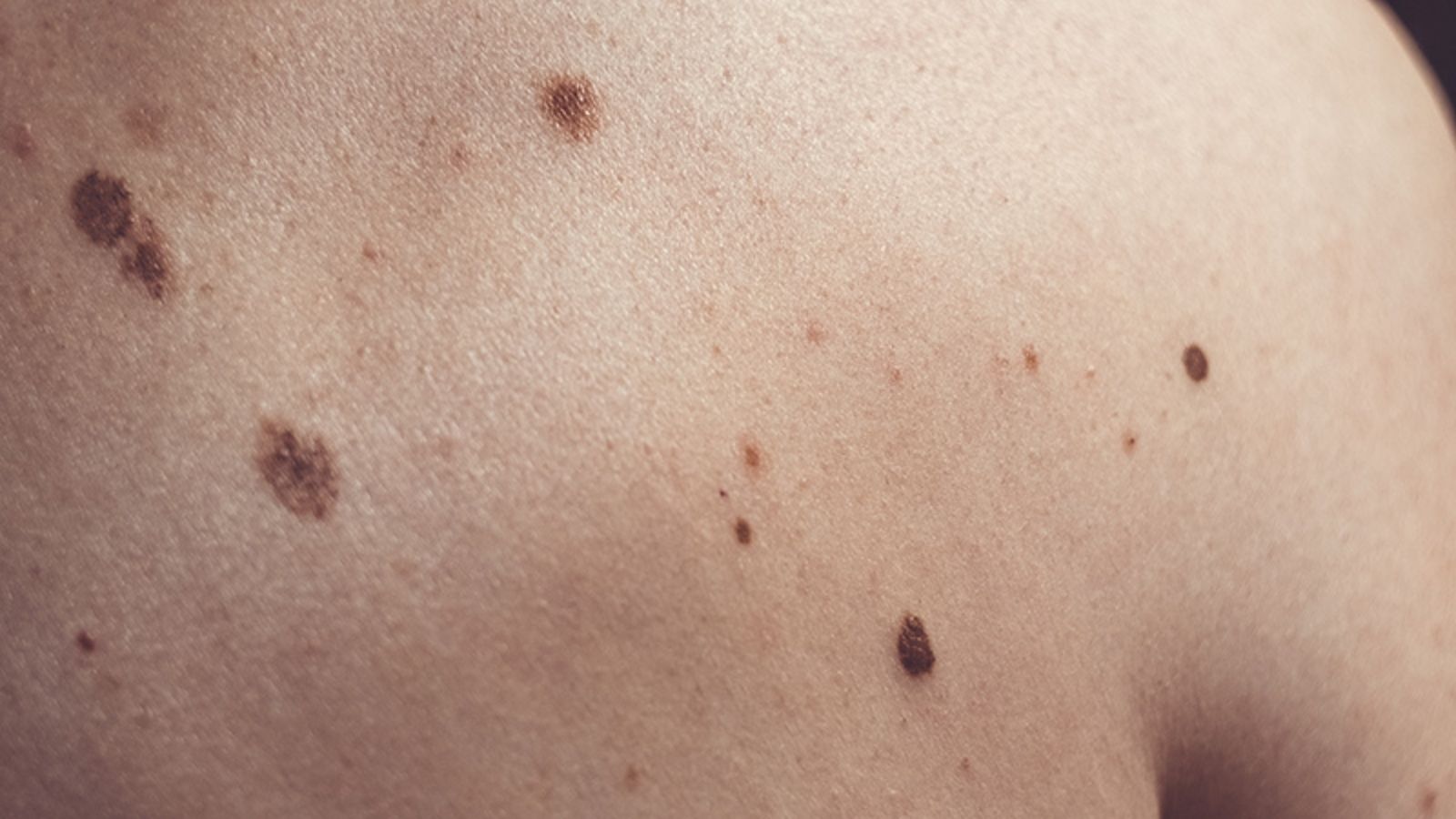 Cilt Hastalıkları 13 Benler (Nevus)