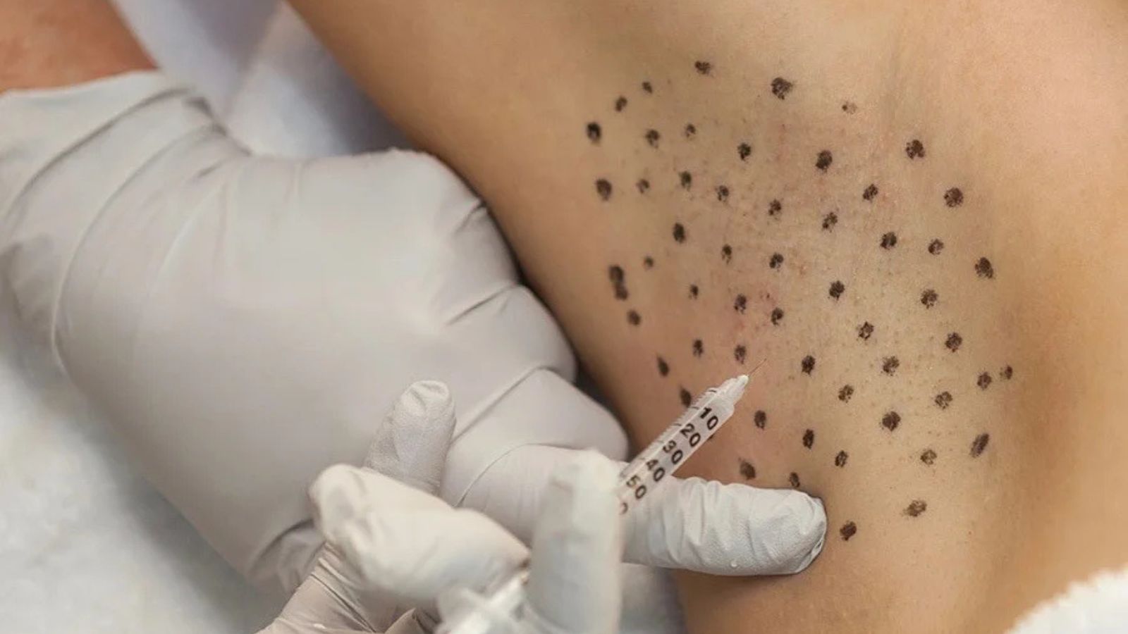 Dermokozmetik Uygulamalar 27 Koltukaltı Terleme Tedavisi