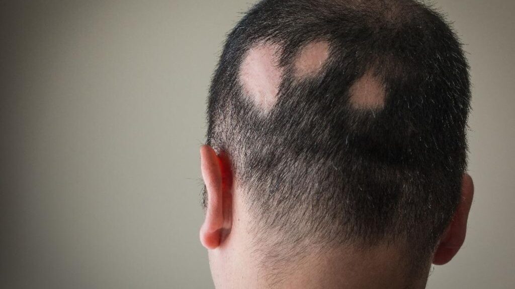 Saç Dökülmeleri (Alopesi)