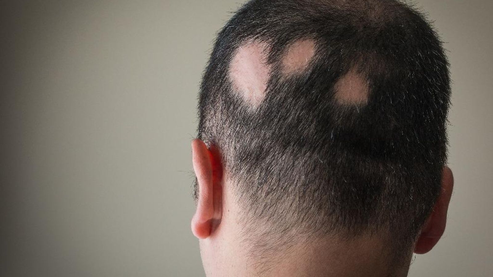 Cilt Hastalıkları 3 Saç Dökülmeleri (Alopesi)