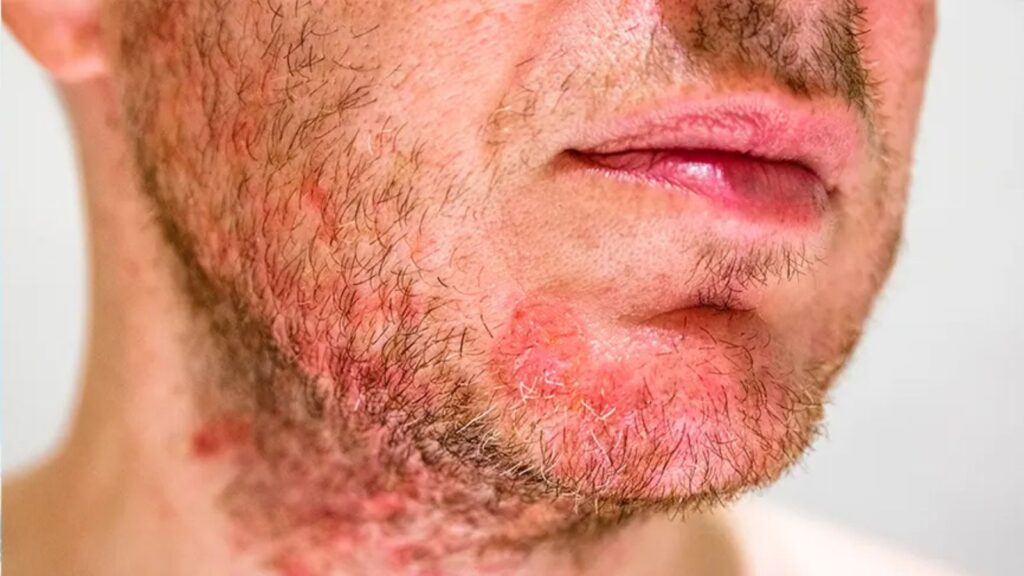Seboreik Dermatit