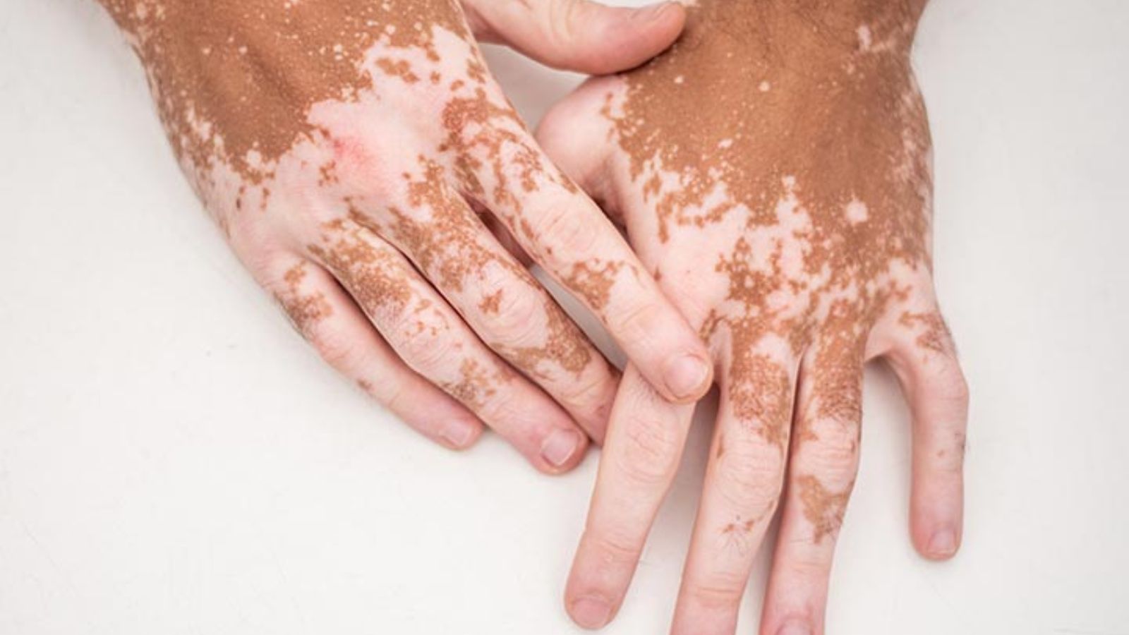Cilt Hastalıkları 9 Vitiligo