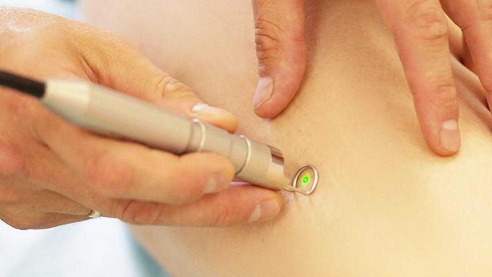 Dermokozmetik Uygulamalar 7 Kılcal Damar Tedavisi