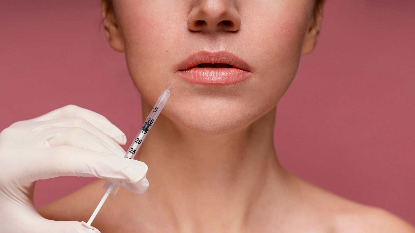 Nazolabial-Dolgu (1)