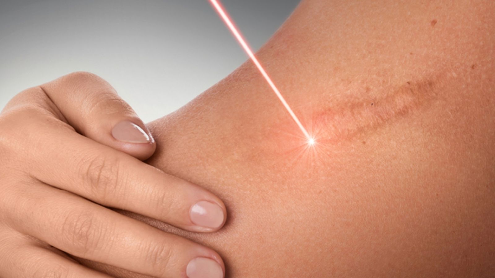 Dermokozmetik Uygulamalar 8 Skar Tedavisi