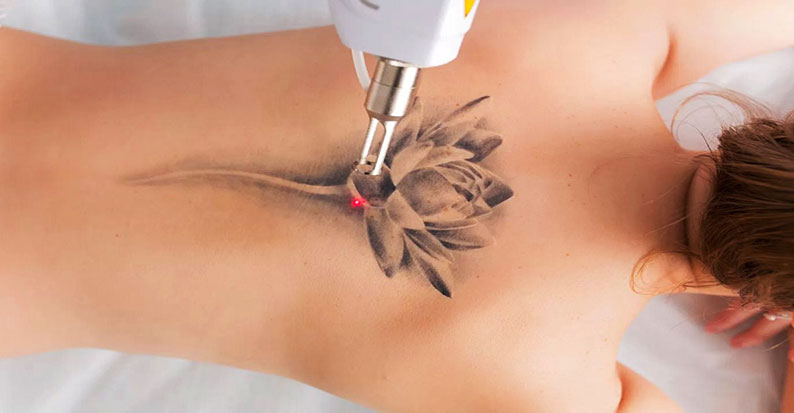 Dermokozmetik Uygulamalar 9 Dövme Silme