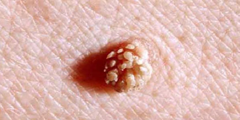 Genital Siğil Tedavisi