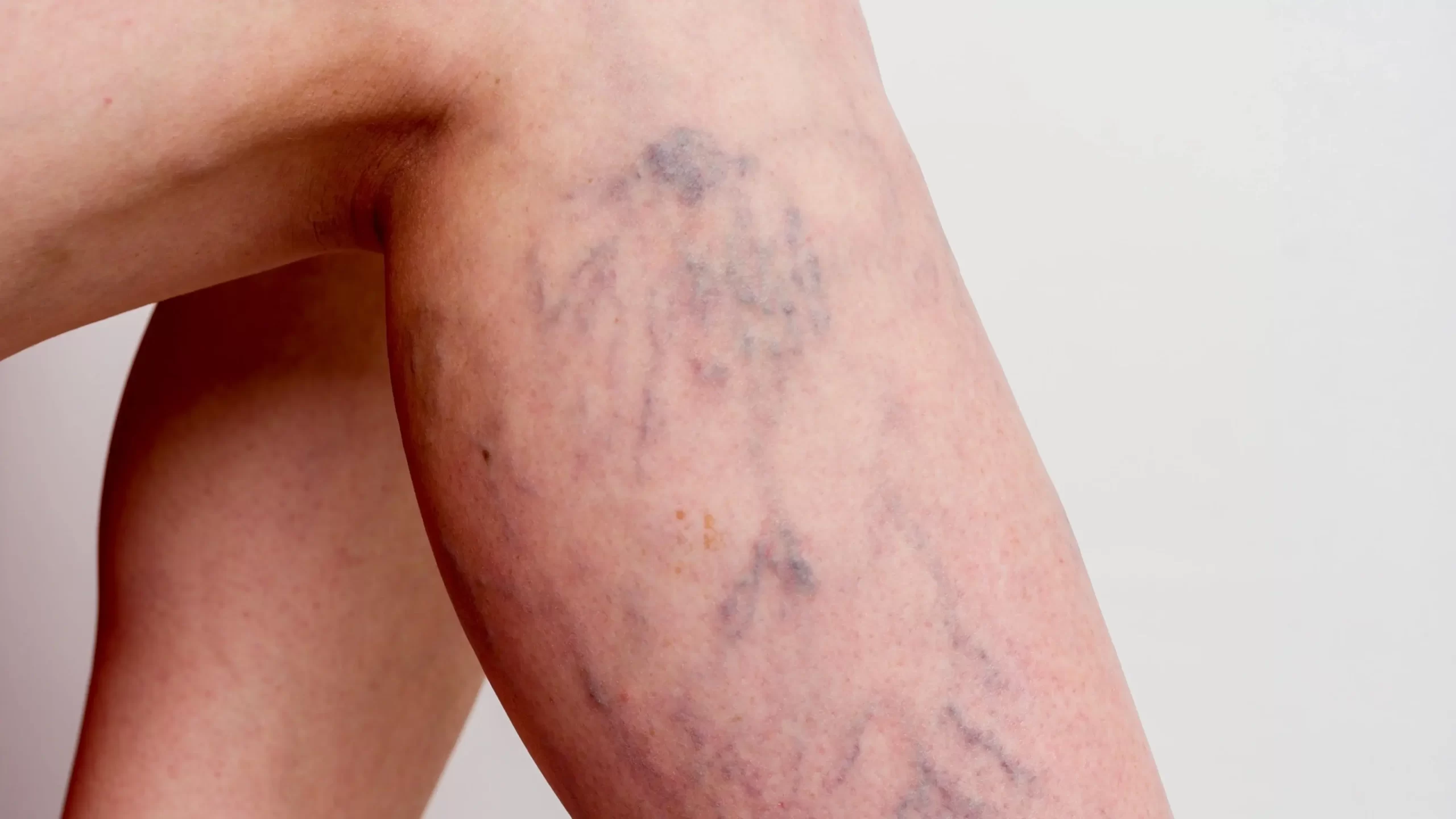 Kılcal Damar Tedavisi