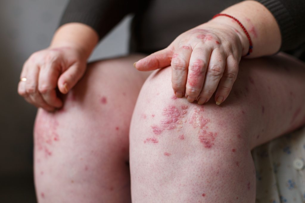 Pruritus