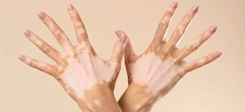 vitiligo tedavisi 1